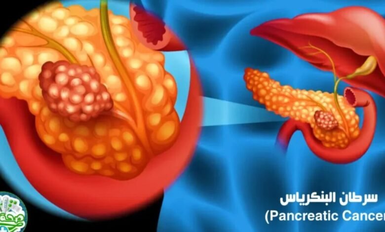 Revolution Medicines تحصل على موافقة أميركية لعلاج سرطان البنكرياس